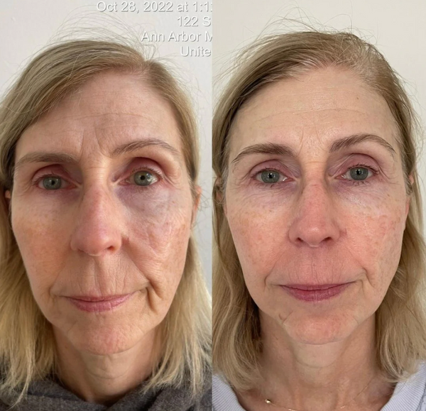 KrX Youthplex Face Lift Toning Solution